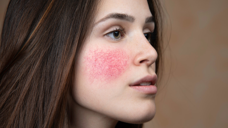 profile of young woman with red rosacea cheek