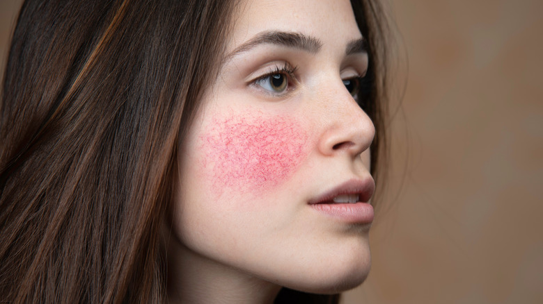 IPL Rosacea Treatments Wimbledon & Kensington