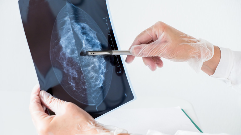 doctor examining mammogram
