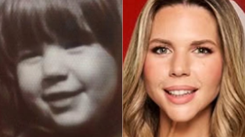 photos of Bec Zacharia as a child with her jaw defect and as an adult after fixing the deficiency