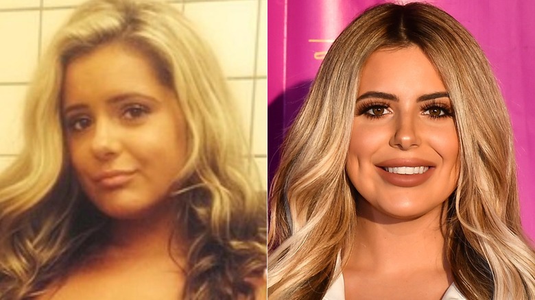 Brielle Biermann before and after she corrected a jaw concern