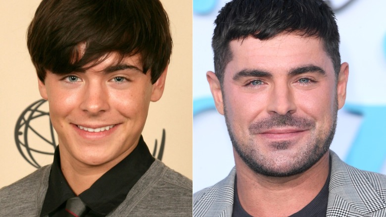 zac efron before and after getting his jaw wired shut and recovering from the injury
