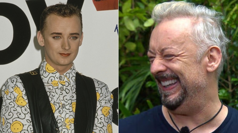 Boy George when he began losing his hair and after hair transplant surgery