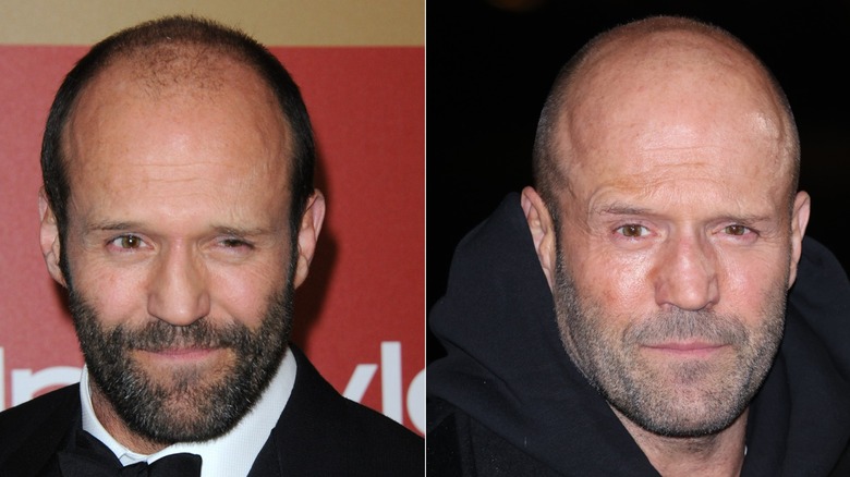 Side-by-side photos showing Jason Statham's hair loss