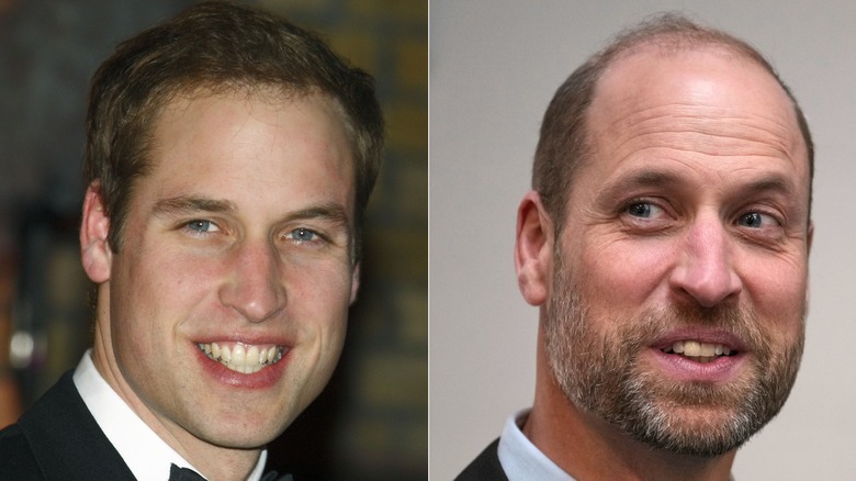 Side-by-side photos showing Prince William's hair loss