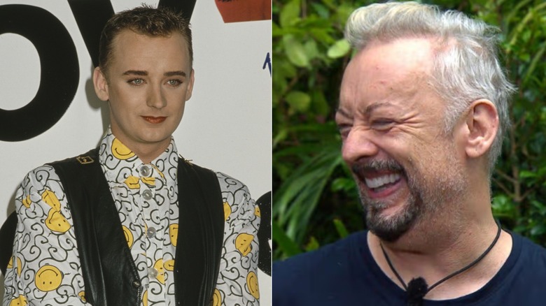 Boy George when he began losing his hair and after hair transplant surgery