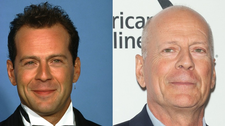 Side-by-side photos showing Bruce Willis' hair loss