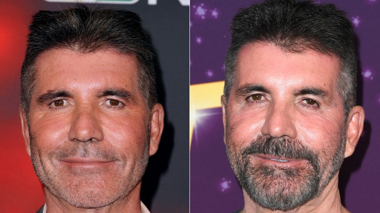 Simon Cowell before and after he dissolved his facial fillers