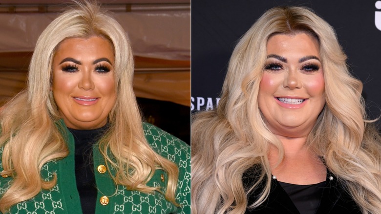 Side-by-side photos showing Gemma Collins before and after using Botox