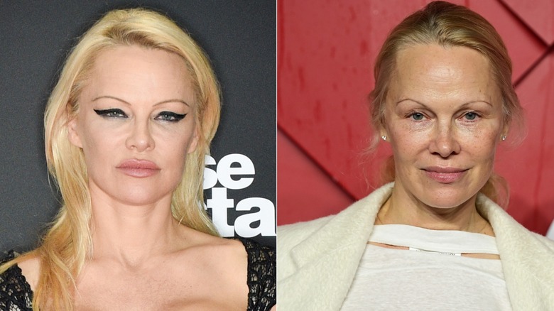 Side-by-side photos showing Pamela Anderson before and after using Botox