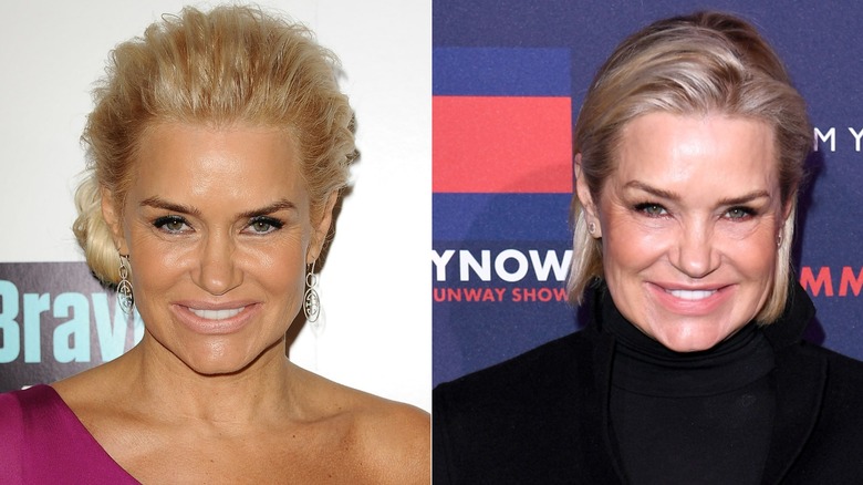 Side-by-side photos showing Yolanda Hadid before and after using Botox