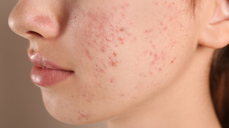 Young woman with acne