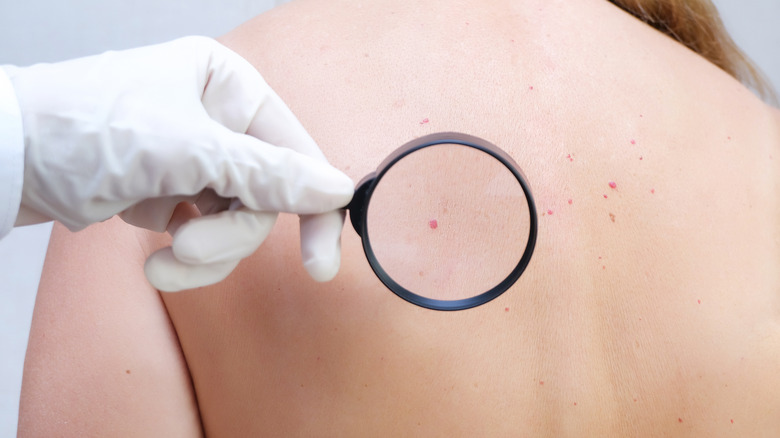 examining skin cancer