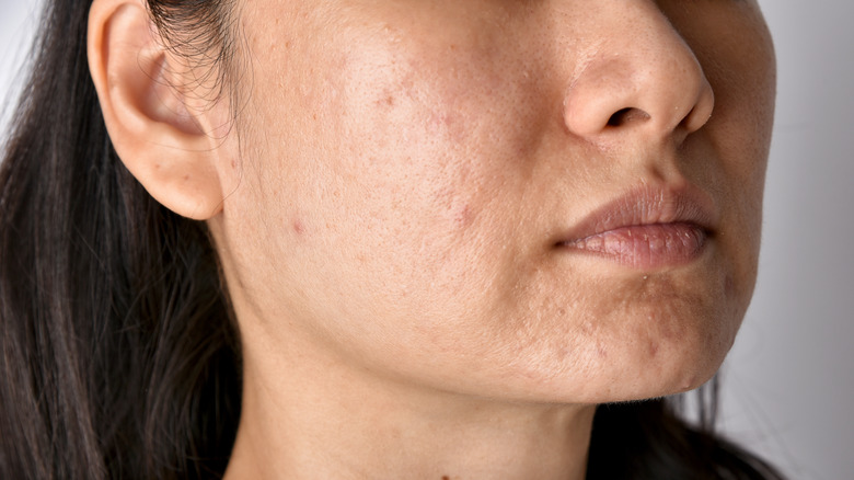 A woman has acne