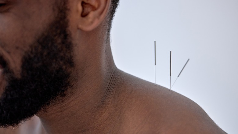 Man receiving acupuncture treatment