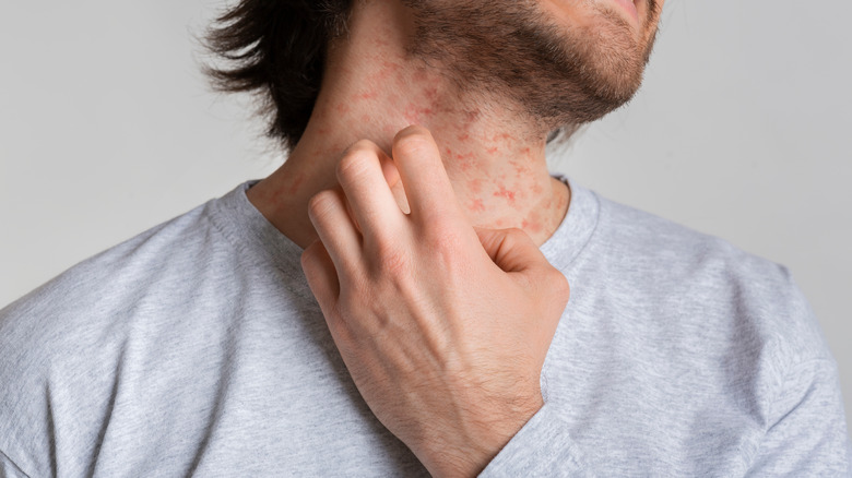 man scratching skin rash