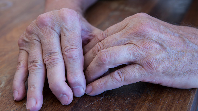 person's hands with arthritis