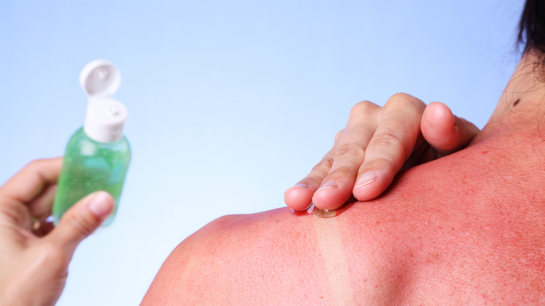 woman applying aloe gel to sunburn