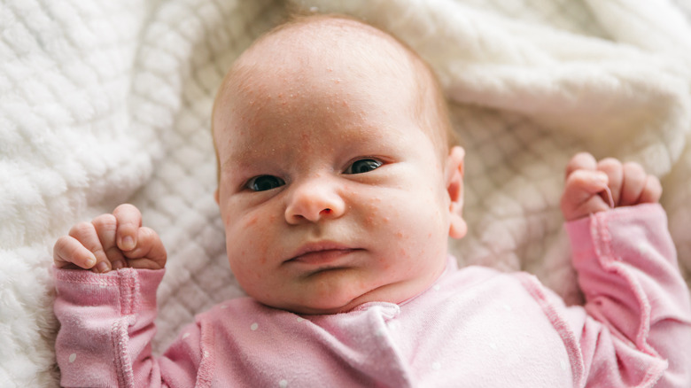 Baby with neonatal acne lying on bed 