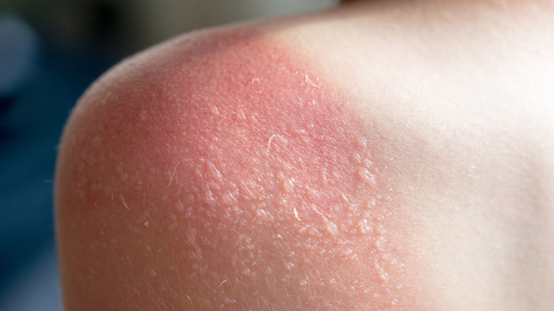 Sunburn blisters on shoulder