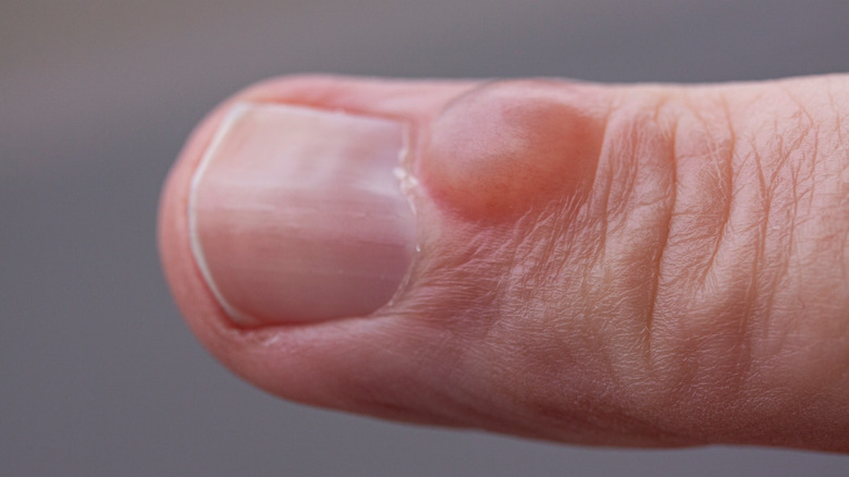 close up of a cyst on an adult finger 