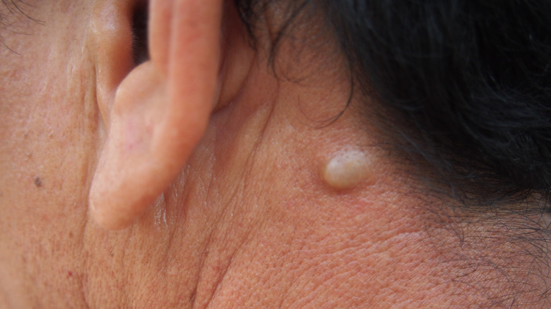 white cyst behind person's ear 