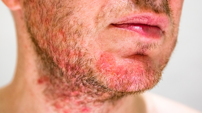 close up of a man with follicultis 