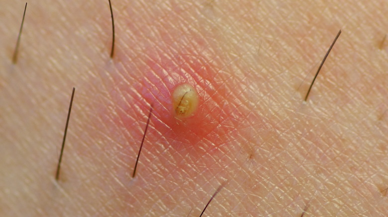 6 Ways To Get Rid Of Ingrown Hairs Once And For All
