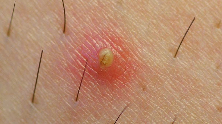 ingrown hair