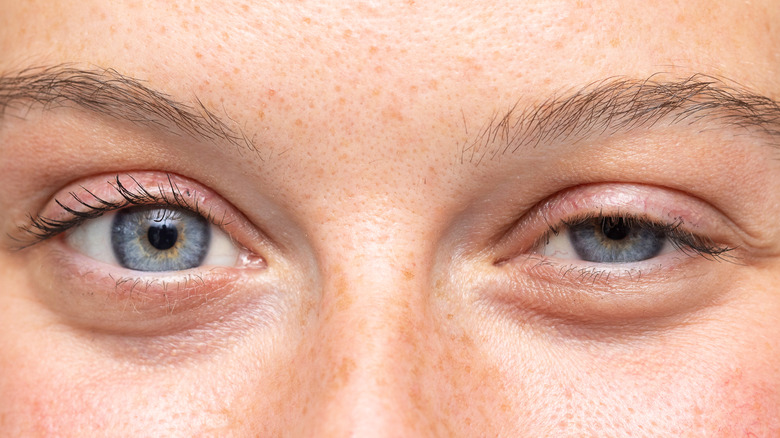 A woman with swollen eye