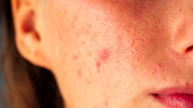 Woman's face with acne