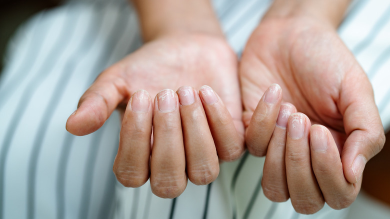 Two hands with nails shown