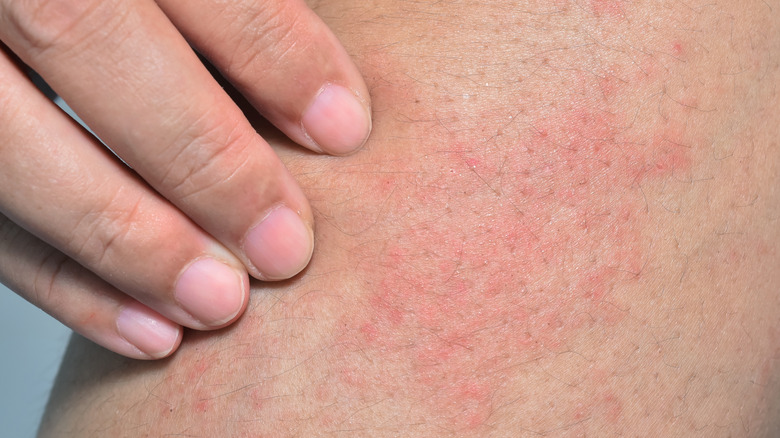 heat rash