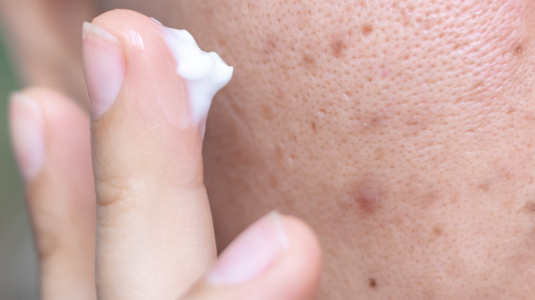 A woman applying acne medication