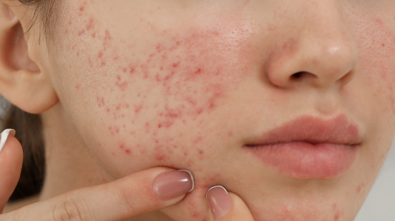 A woman looking at her acne