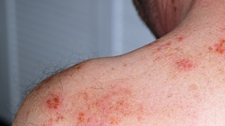 Shingles rash on a person's shoulder