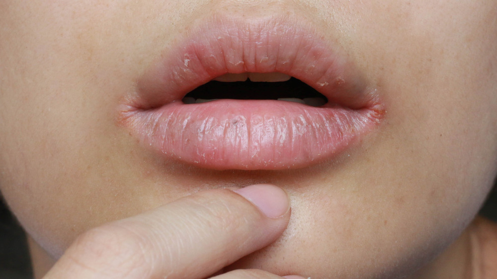Dry, chapped lips