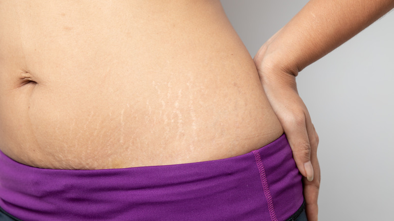 stretch marks on abdomen