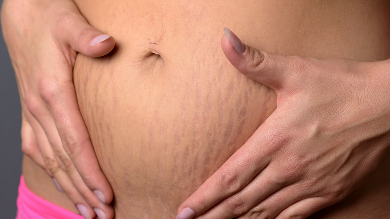 pregnant woman with stretch marks