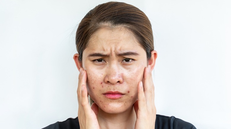 young woman with acne