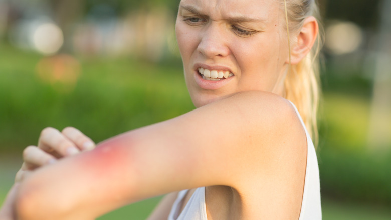 Woman scratches a bug bite on her arm