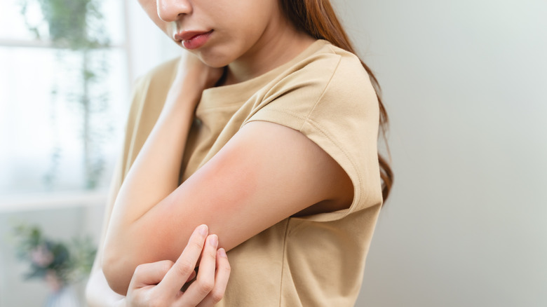 A woman scratching her arm, which looks red and swollen