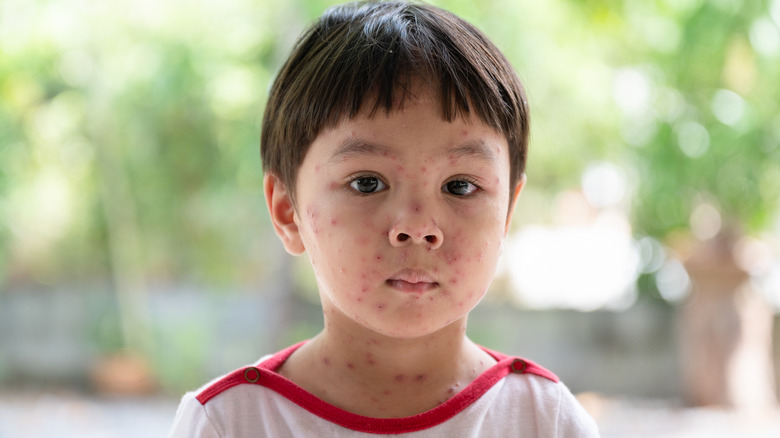 boy with chickenpox