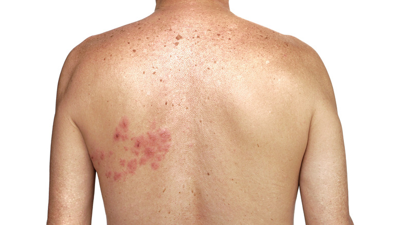 shingles on man's back