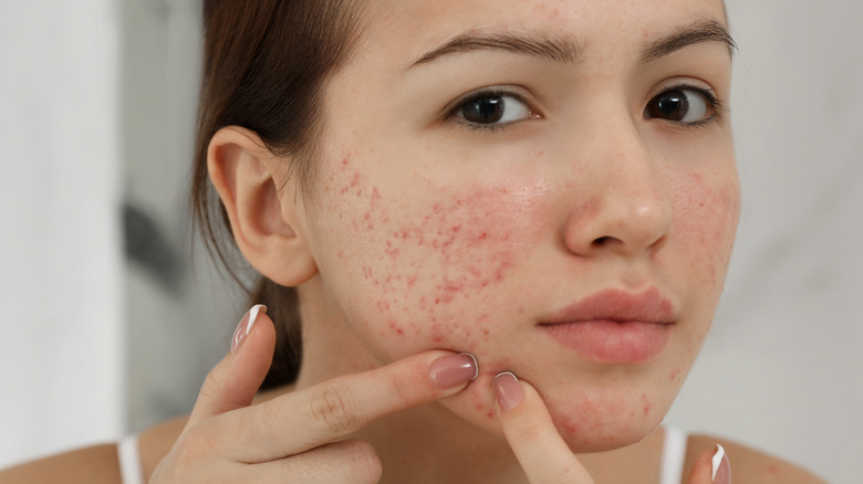 Teen girl with acne