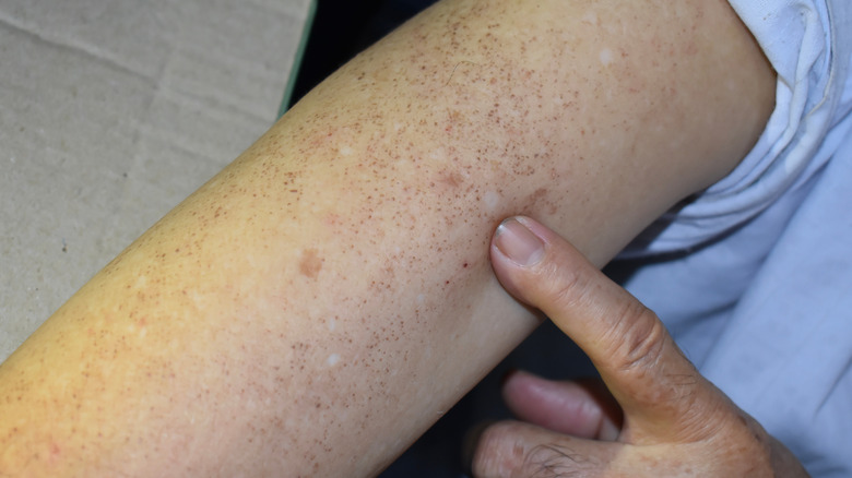 Age Spots (Solar Lentigo, Liver Spots) - Harvard Health