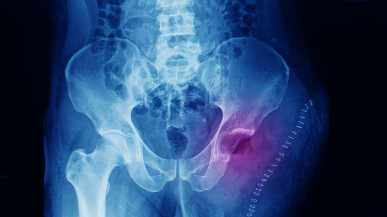 x-ray of bone tumor at the thigh