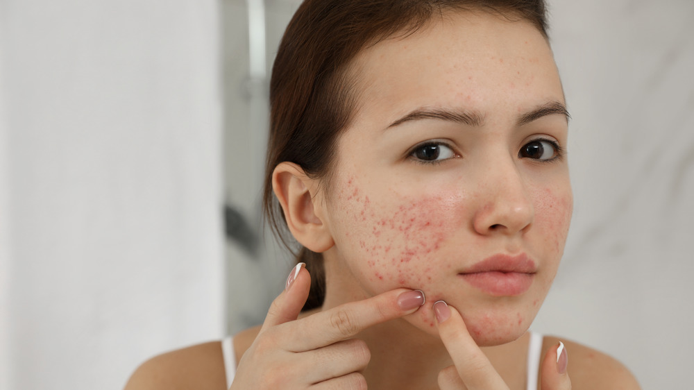 Woman touching her acne