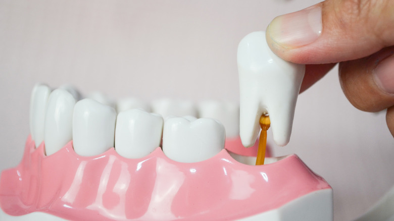 Wisdom tooth in model of gums