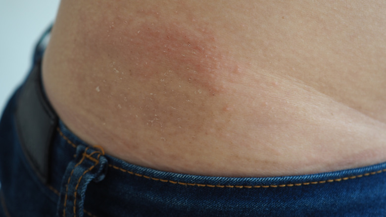 rash on woman's waist
